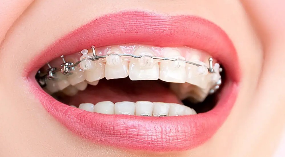 过了矫牙黄金期才去矫正会不会影响效果？