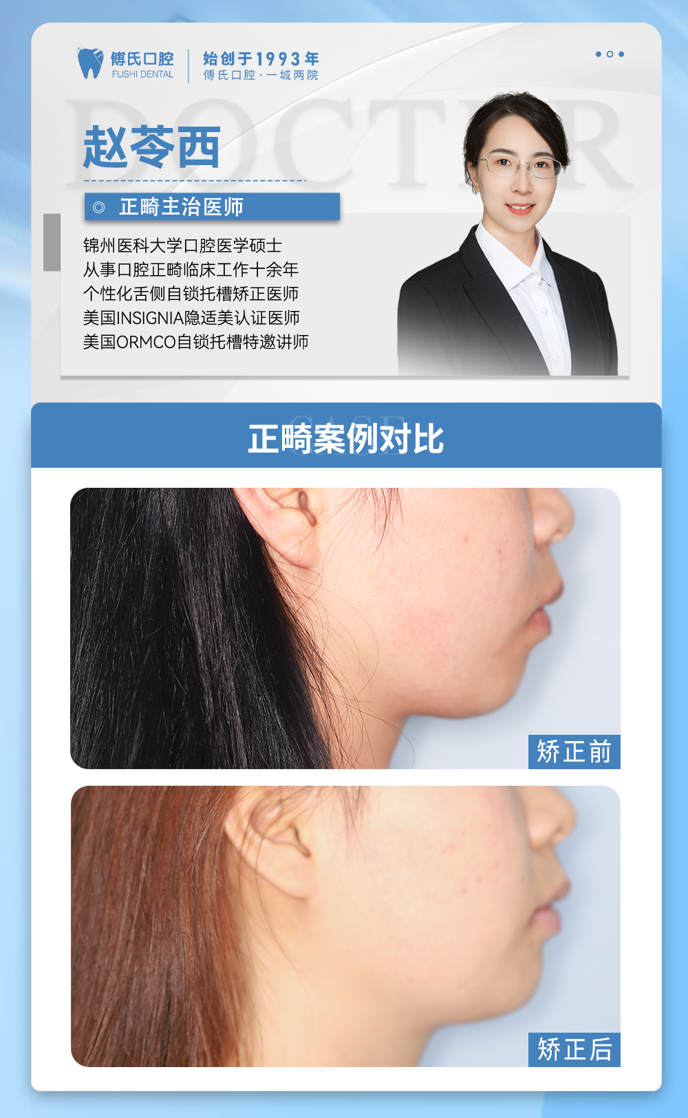 义乌傅氏口腔牙列不齐,下巴后缩矫正案例分享! 义乌傅氏口腔牙列不齐,下巴后缩矫正案例分享!