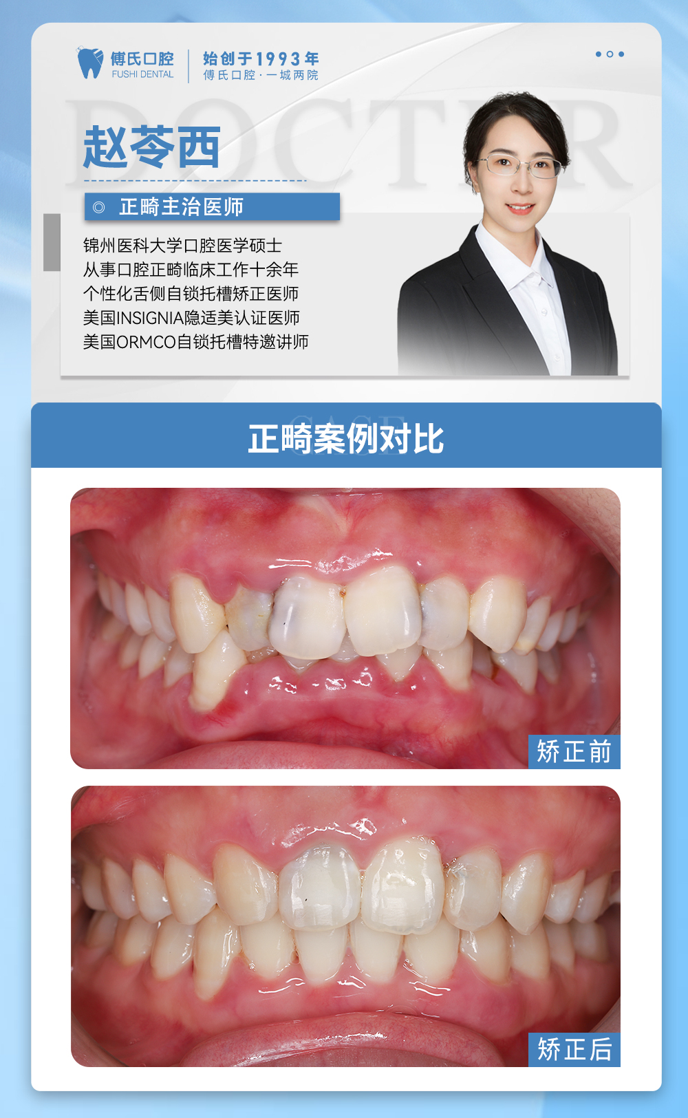 义乌傅氏口腔牙列不齐,下巴后缩矫正案例分享! 义乌傅氏口腔牙列不齐,下巴后缩矫正案例分享!