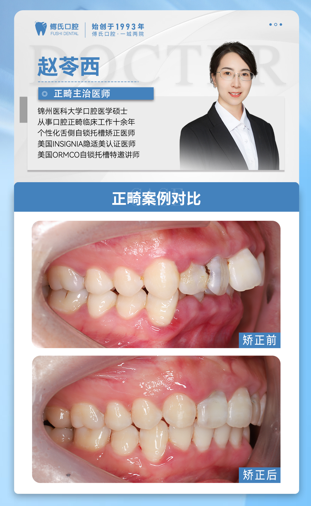 义乌傅氏口腔牙列不齐,下巴后缩矫正案例分享! 义乌傅氏口腔牙列不齐,下巴后缩矫正案例分享!
