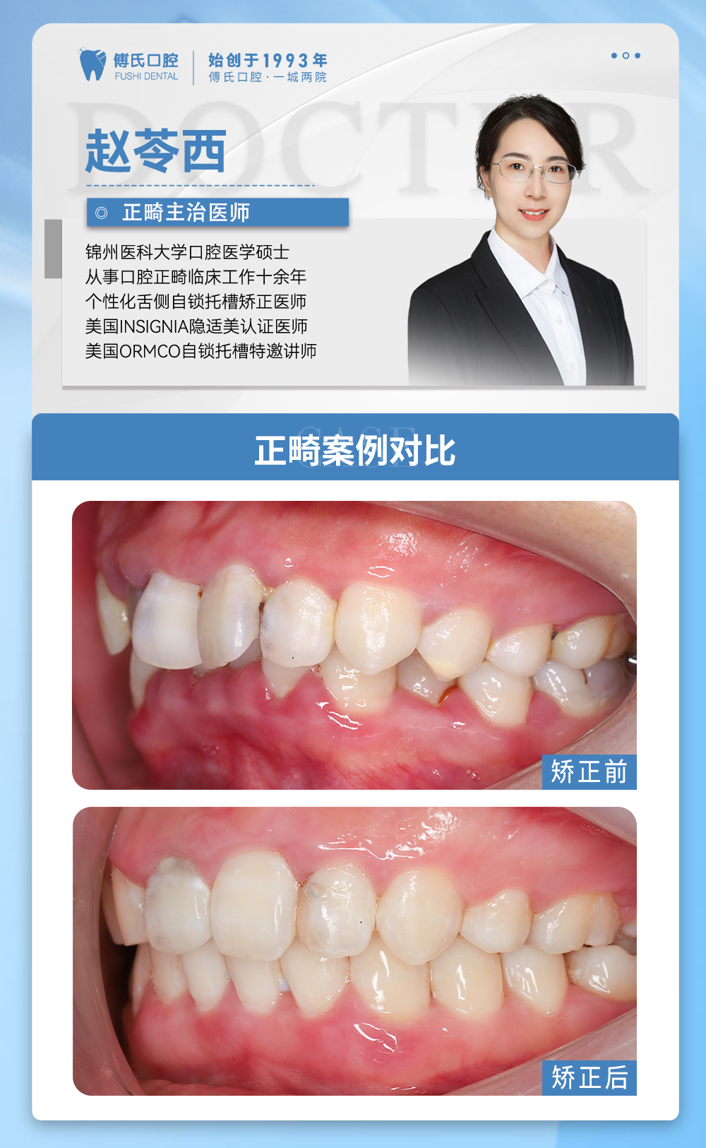 义乌傅氏口腔牙列不齐,下巴后缩矫正案例分享! 义乌傅氏口腔牙列不齐,下巴后缩矫正案例分享!