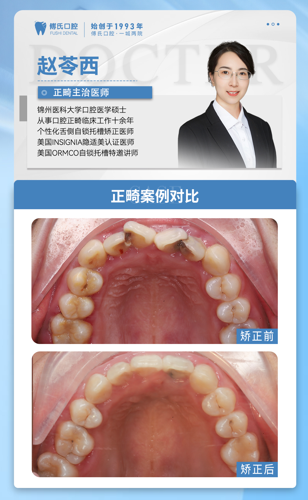 义乌傅氏口腔牙列不齐,下巴后缩矫正案例分享! 义乌傅氏口腔牙列不齐,下巴后缩矫正案例分享!