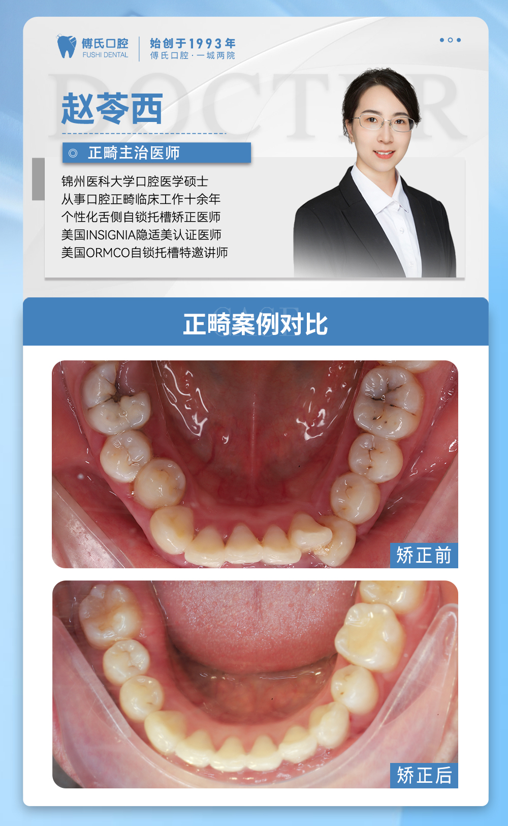 义乌傅氏口腔牙列不齐,下巴后缩矫正案例分享! 义乌傅氏口腔牙列不齐,下巴后缩矫正案例分享!