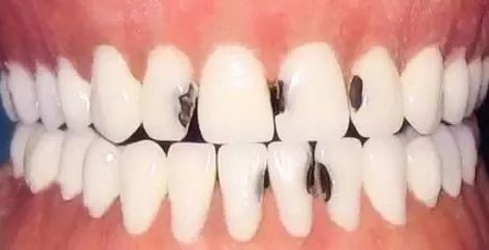 这些食物毁牙! 这些食物毁牙!