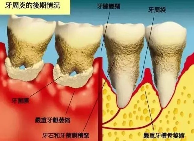 牙齿祸害,牙周炎的前世今生! 牙齿祸害,牙周炎的前世今生!