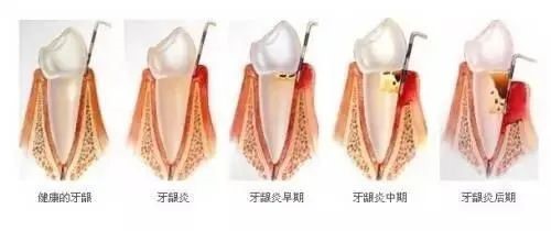 牙齿祸害,牙周炎的前世今生! 牙齿祸害,牙周炎的前世今生!