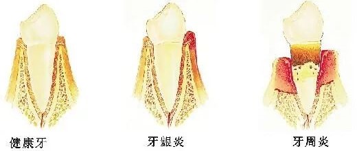 不容忽视的牙周炎! 不容忽视的牙周炎!