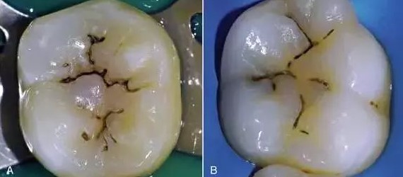 牙齿有黑线就一定是蛀牙吗? 牙齿有黑线就一定是蛀牙吗?