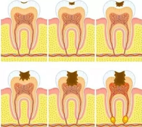 牙齿有黑线就一定是蛀牙吗? 牙齿有黑线就一定是蛀牙吗?