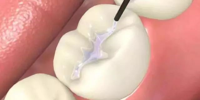 牙齿有黑线就一定是蛀牙吗? 牙齿有黑线就一定是蛀牙吗?