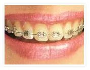 牙齿矫治器很多，如何选才能逆袭畸形的牙齿？—义乌傅氏口腔