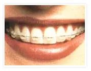 牙齿矫治器很多，如何选才能逆袭畸形的牙齿？—义乌傅氏口腔