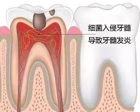 牙髓炎