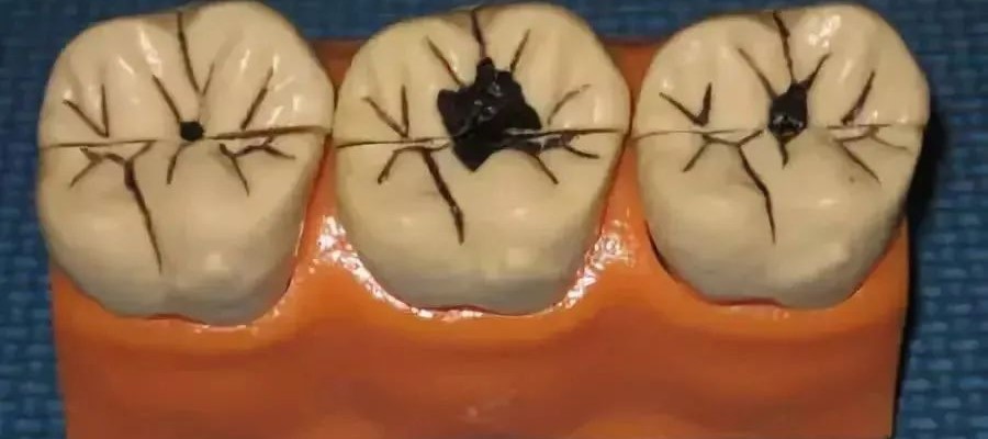 保护“六龄齿” 谨记这三招！