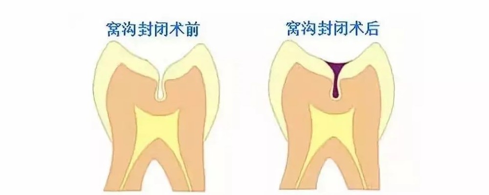 保护“六龄齿” 谨记这三招！