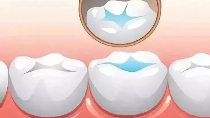 保护“六龄齿” 谨记这三招！