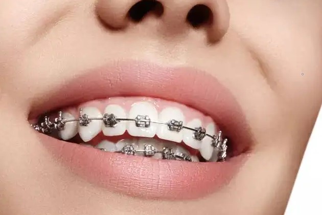 牙齿矫正