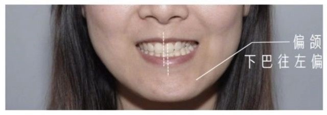 牙齿上下中线没有对齐，下巴偏向左边、以及面部不对称。