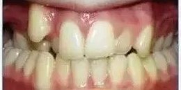 牙齿畸形，凸嘴如何矫正？—义乌傅氏口腔