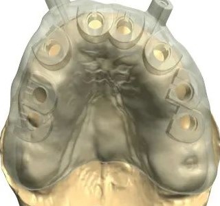 口腔种植还有禁忌症? 口腔种植还有禁忌症?