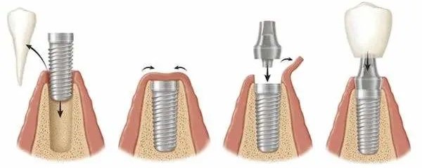 种植流程 种植流程