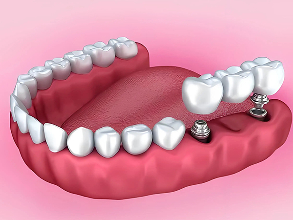 种植牙可以管多少年？年轻人缺牙种牙能用多久？—义乌口腔种植
