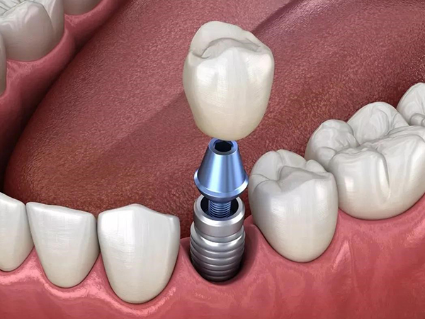 种植牙可以管多少年？年轻人缺牙种牙能用多久？—义乌口腔种植