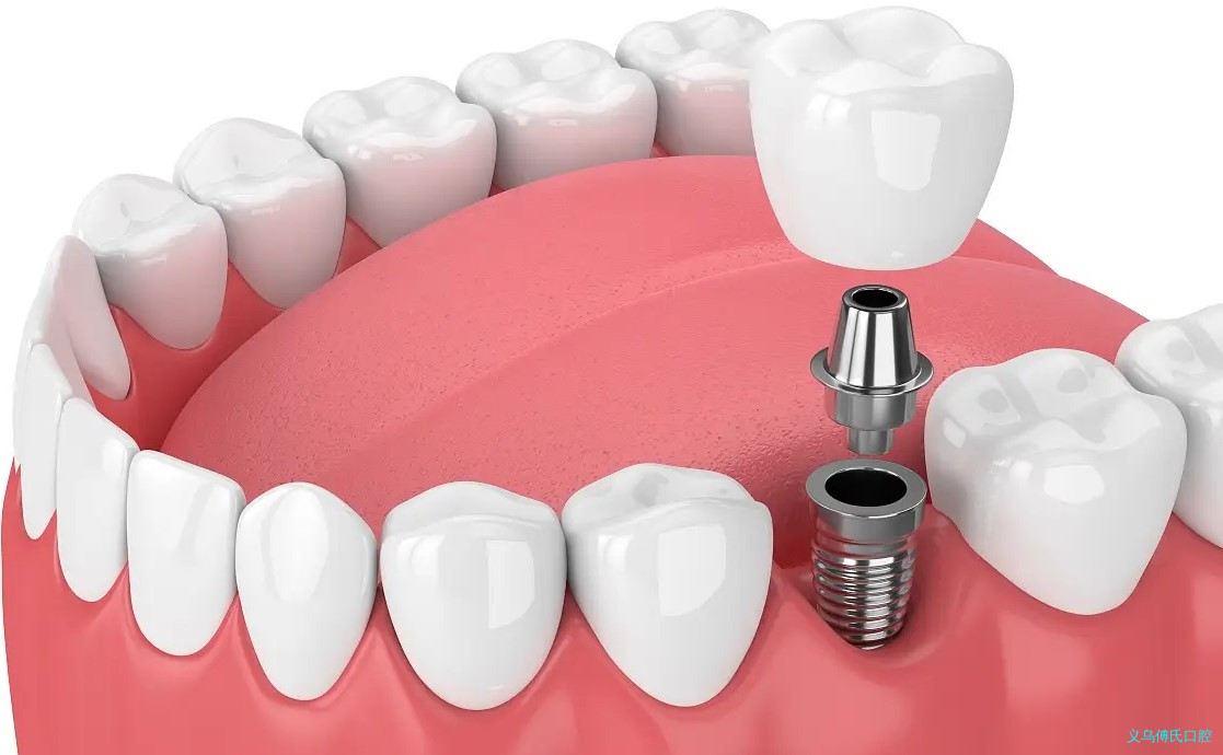 种牙后需要做哪些保护措施？哪些行为会让种植牙寿命减少？—义乌口腔修复