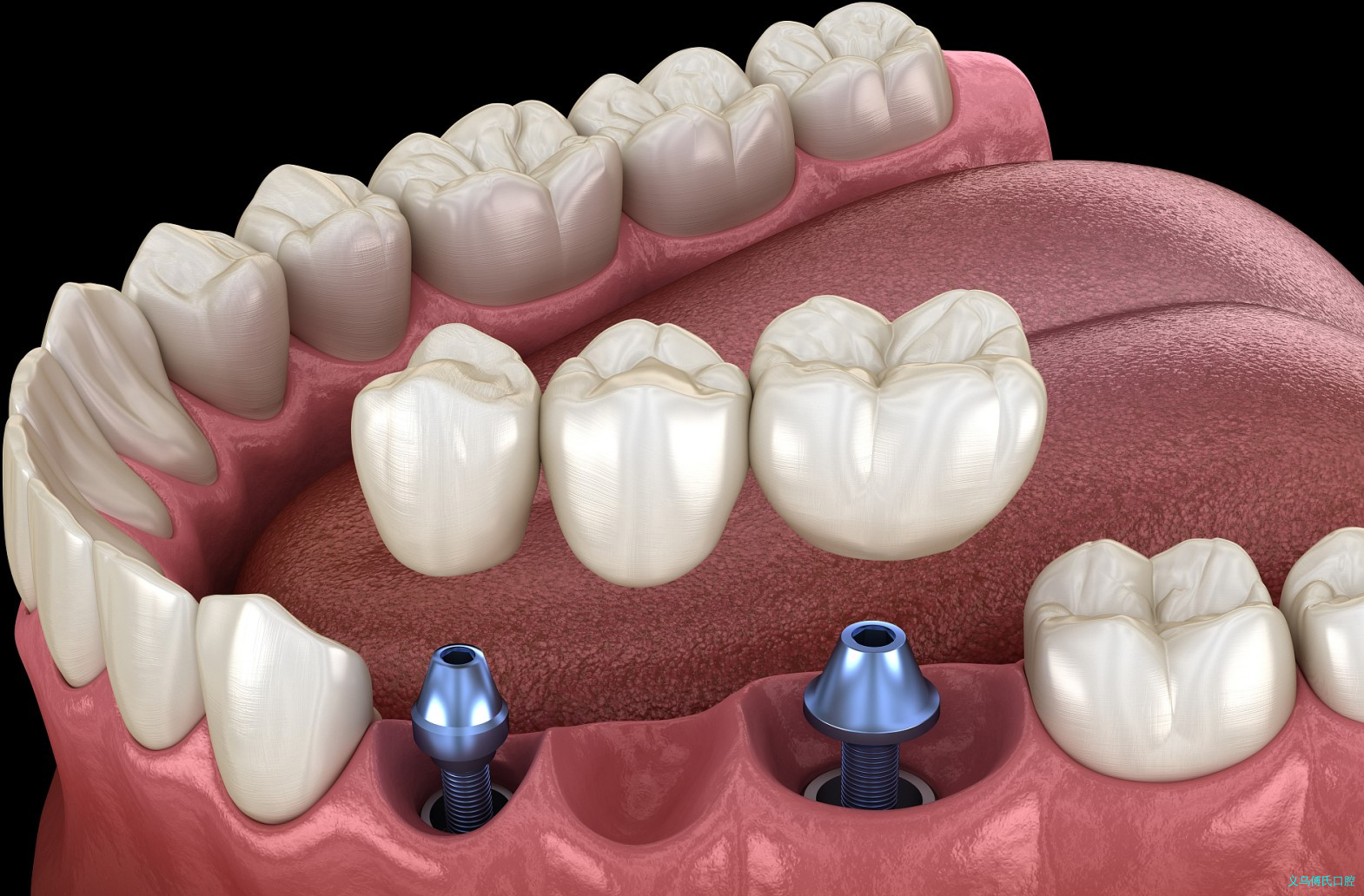 种牙后需要做哪些保护措施？哪些行为会让种植牙寿命减少？—义乌口腔修复