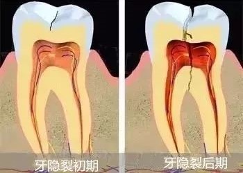 突然咬到小石头牙齿剧痛！很不幸，牙隐裂！