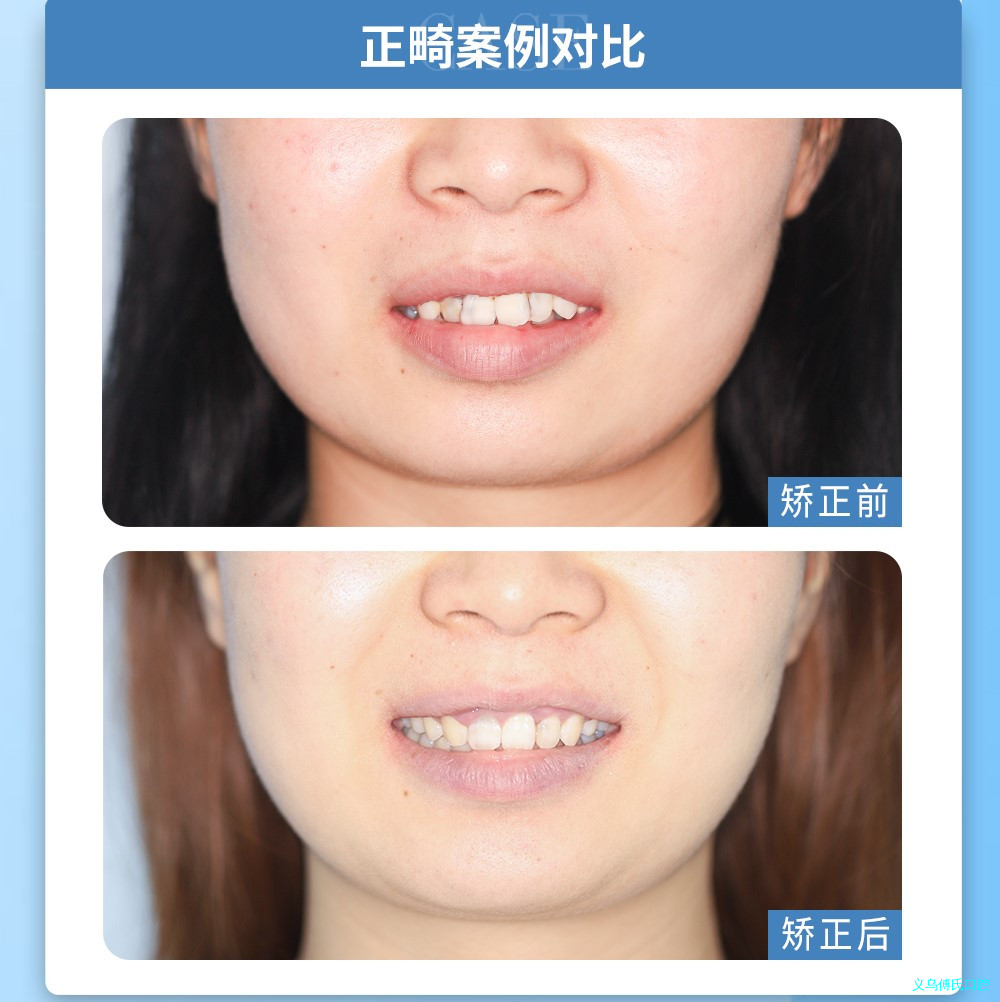牙齿畸形的原因是什么?—义乌牙齿矫正 牙齿畸形的原因是什么?—义乌牙齿矫正