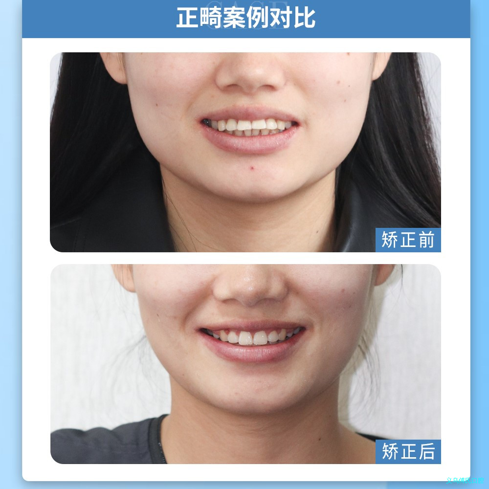 牙齿畸形的原因是什么?—义乌牙齿矫正 牙齿畸形的原因是什么?—义乌牙齿矫正