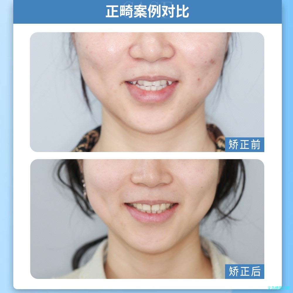 牙齿畸形的原因是什么?—义乌牙齿矫正 牙齿畸形的原因是什么?—义乌牙齿矫正