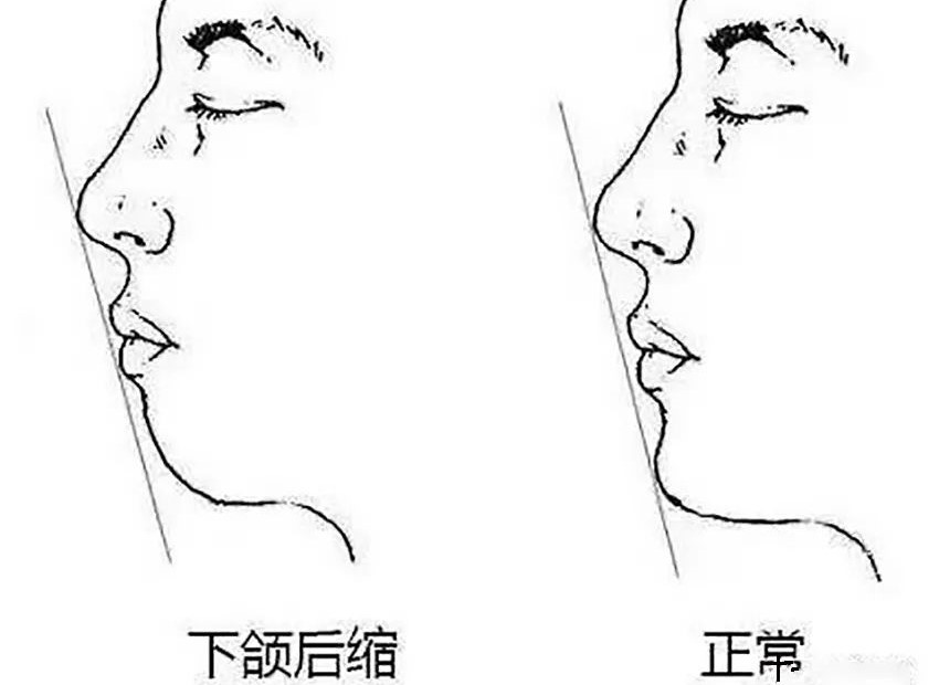 12岁前须处理的儿童牙颌畸形! 12岁前须处理的儿童牙颌畸形!