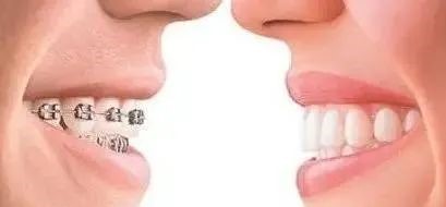 矫正拔牙:三种人必拔,五种人不能拔! 矫正拔牙:三种人必拔,五种人不能拔!