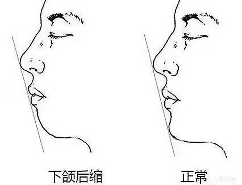 矫正拔牙:三种人必拔,五种人不能拔! 矫正拔牙:三种人必拔,五种人不能拔!