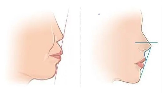 牙齿前突如何造成的,不矫正有危害吗,矫正效果好吗?—义乌傅氏口腔 牙齿前突如何造成的,不矫正有危害吗,矫正效果好吗?—义乌傅氏口腔