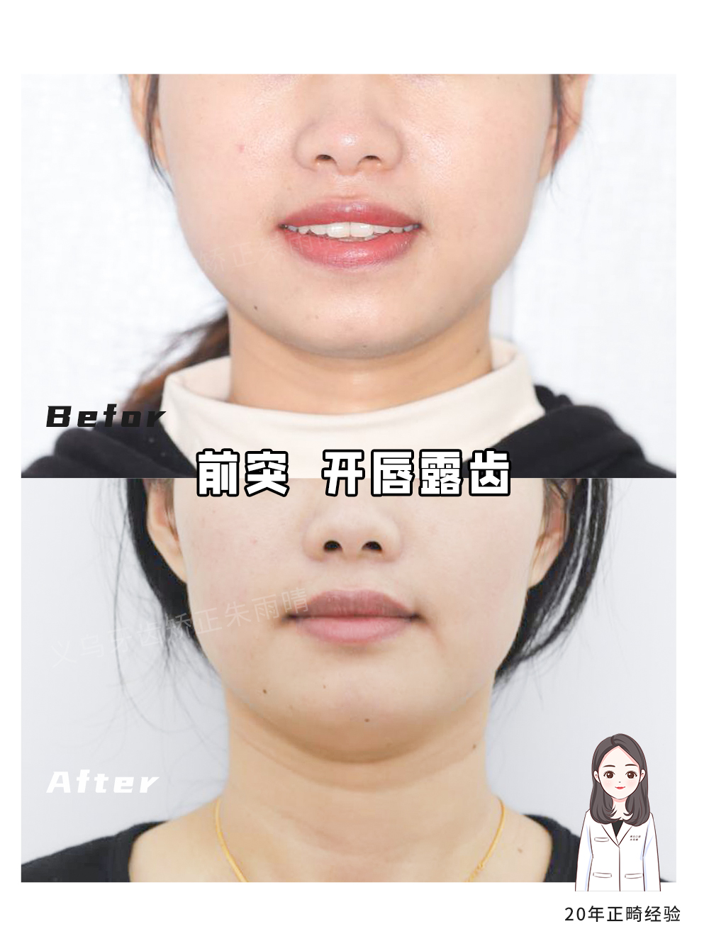 义乌傅氏口腔嘴凸开唇露齿矫正案例分享！