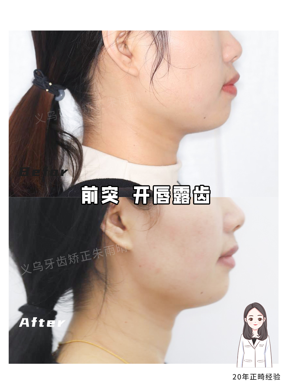 义乌傅氏口腔嘴凸开唇露齿矫正案例分享！