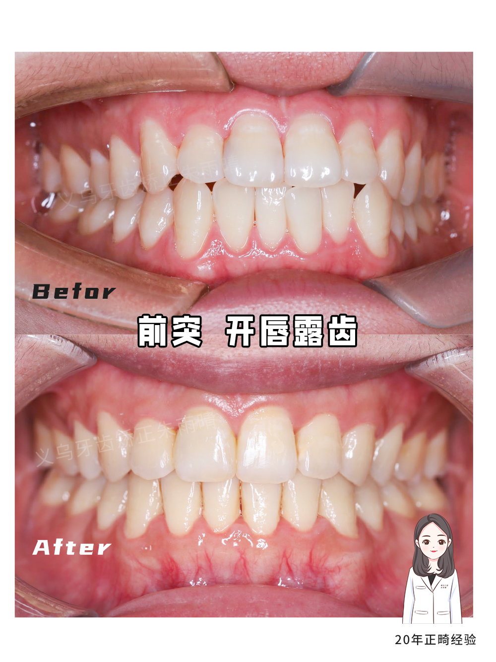 义乌傅氏口腔嘴凸开唇露齿矫正案例分享！