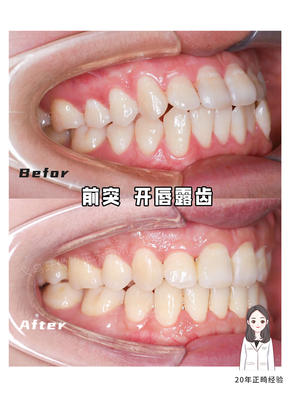 义乌傅氏口腔嘴凸开唇露齿矫正案例分享！