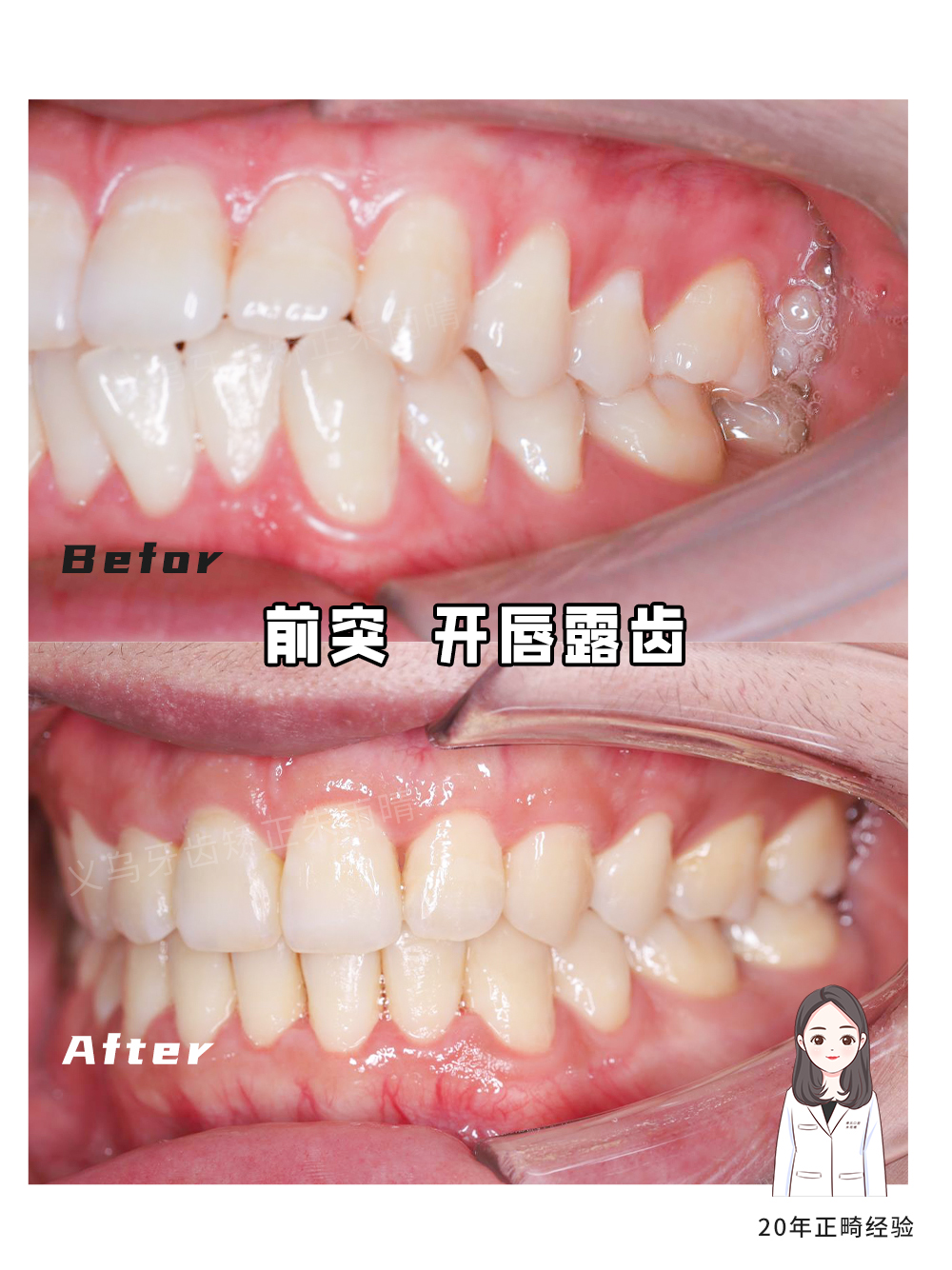 义乌傅氏口腔嘴凸开唇露齿矫正案例分享！