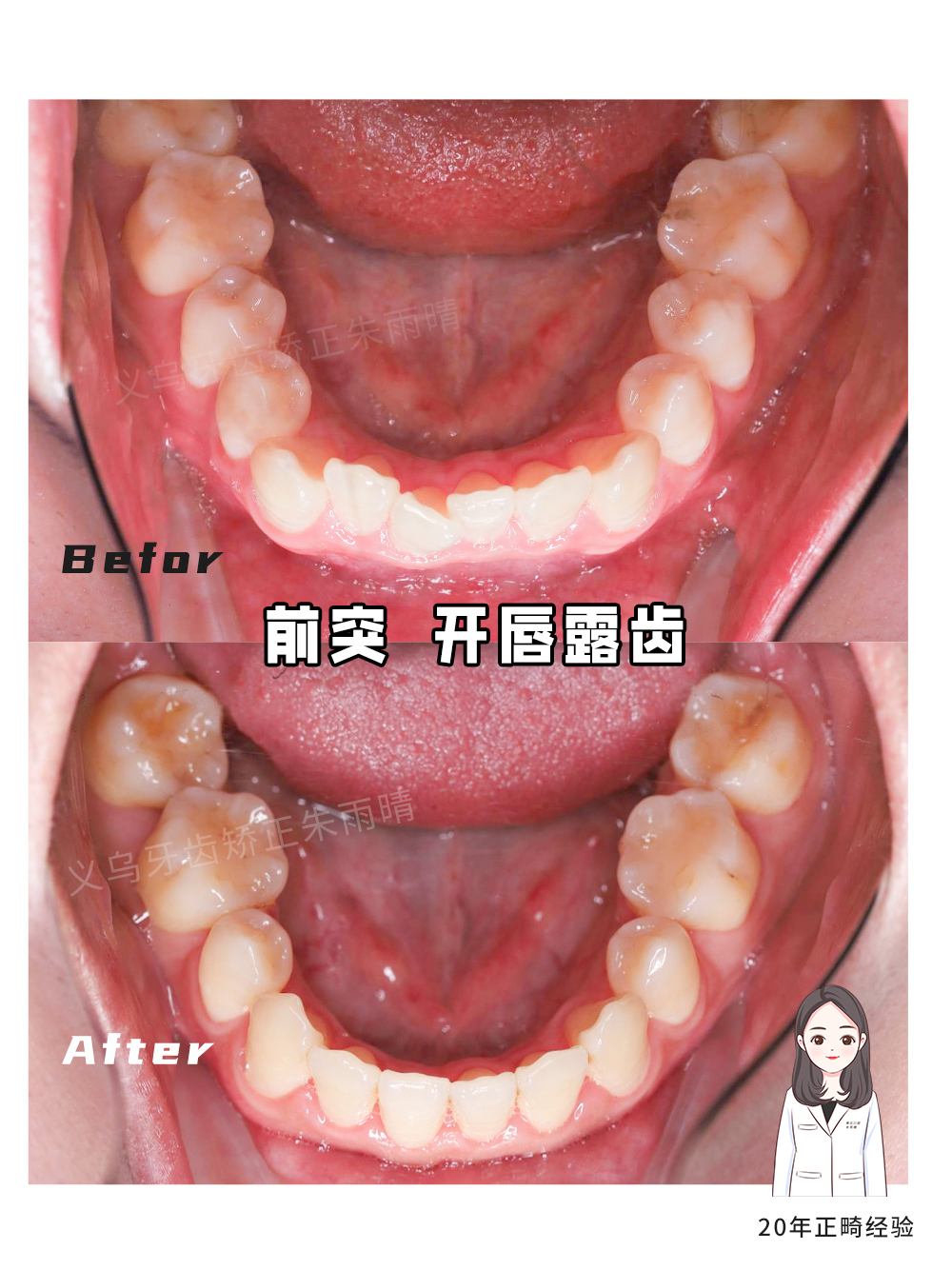 义乌傅氏口腔嘴凸开唇露齿矫正案例分享！