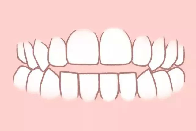 开颌是怎么回事？—义乌傅氏口腔