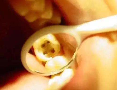 五个不同牙位的开髓改良操作！—义乌傅氏口腔