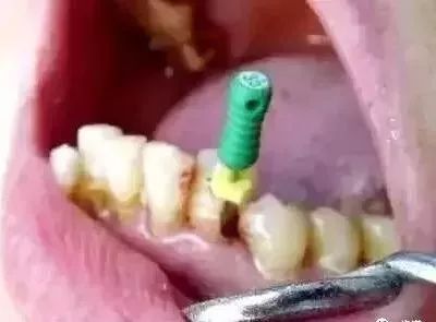 图4：33远中唇龋，舌面完好，直接开髓，扩大针深入情况