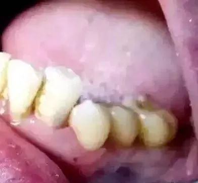 图5：玻璃离子暂时充填后情况