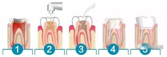 根管治疗这么贵,是不是被坑了?—义乌傅氏口腔 根管治疗这么贵,是不是被坑了?—义乌傅氏口腔