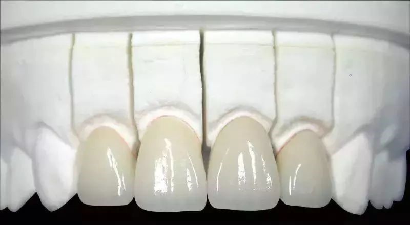 镍铬、钴铬、贵金属和全瓷牙那个好？