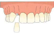 缺了颗牙，必须做种植牙吗？—义乌傅氏口腔